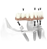 implantes